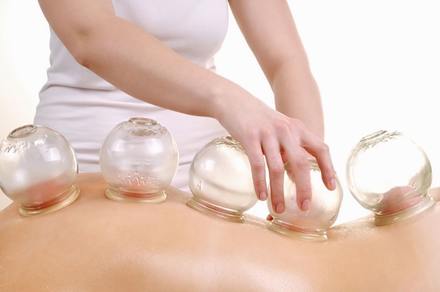 How cupping works - DREAMSTIME