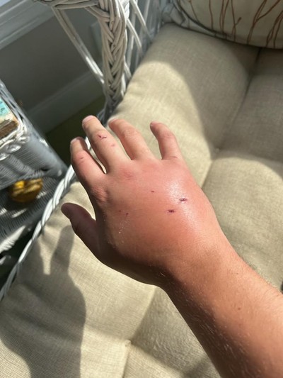 CJ Woods' hand after being bitten - COURTESY OF CJ WOODS