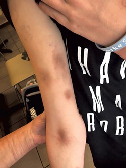 Bruises on Logan Huysman's arm - COURTESY OF LOGAN HUYSMAN